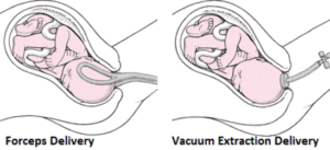 normal_forceps_and_vacuum_birth